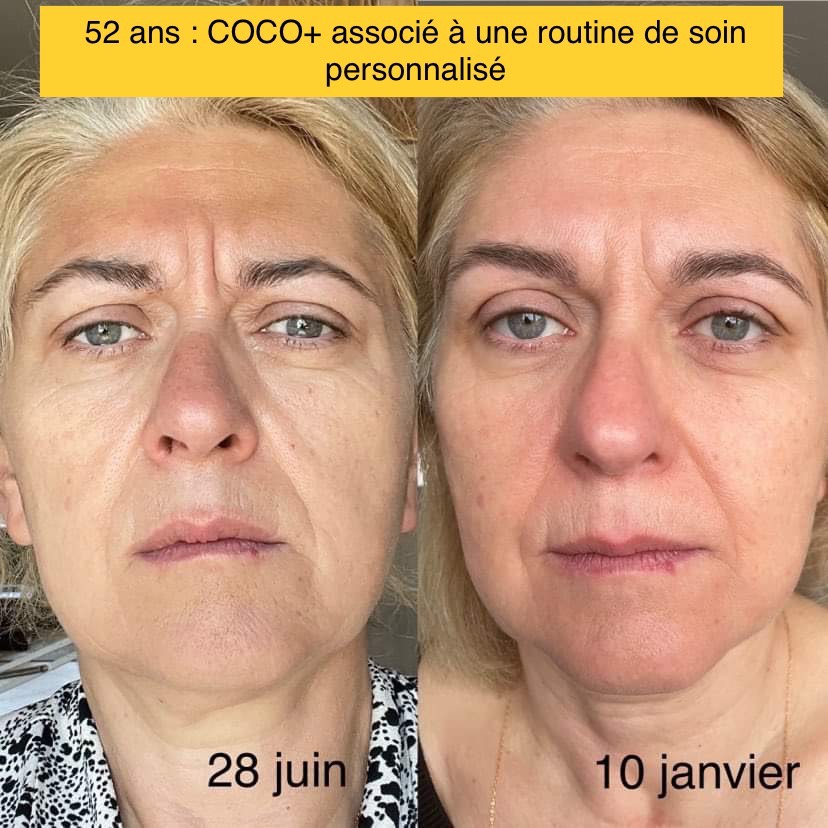 photo avant après présentant une femme de 52 ans après une cure de 6 mois de collagène